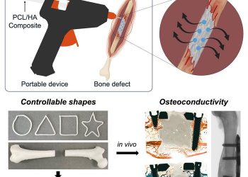 研究人员直接在手术室开发了骨植入物的3D打印工具
